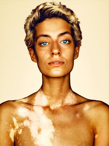 Vitiligo