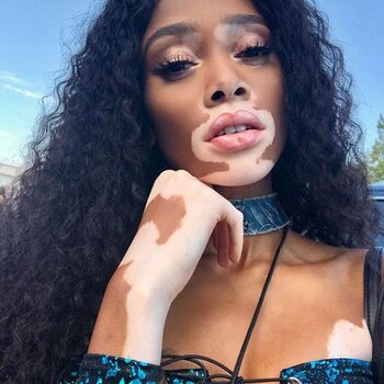 Winnie Harlow